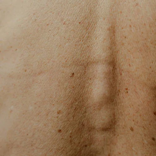 Back with freckles and dark pigmentation spots