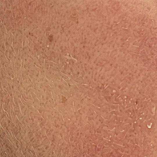 Close-up van droge, licht schilferende huid met fijne haartjes